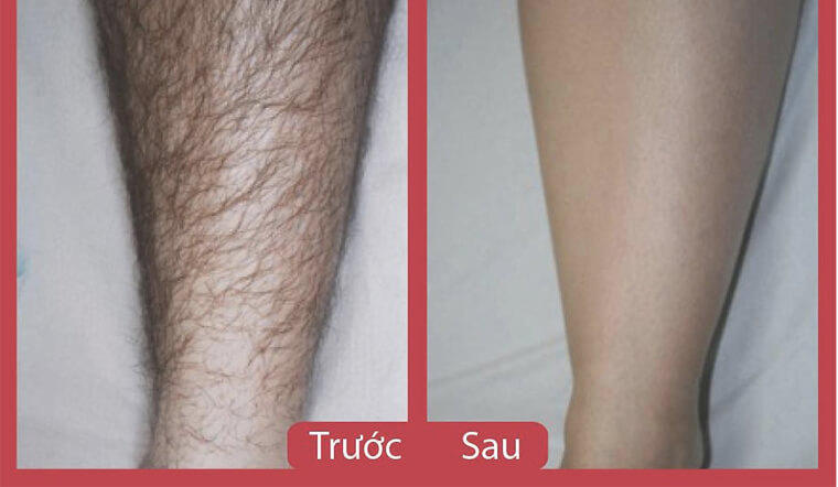 Hiệu quả của phương pháp triệt lông vĩnh viễn