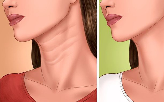 Cách trị nếp nhăn ở cổ