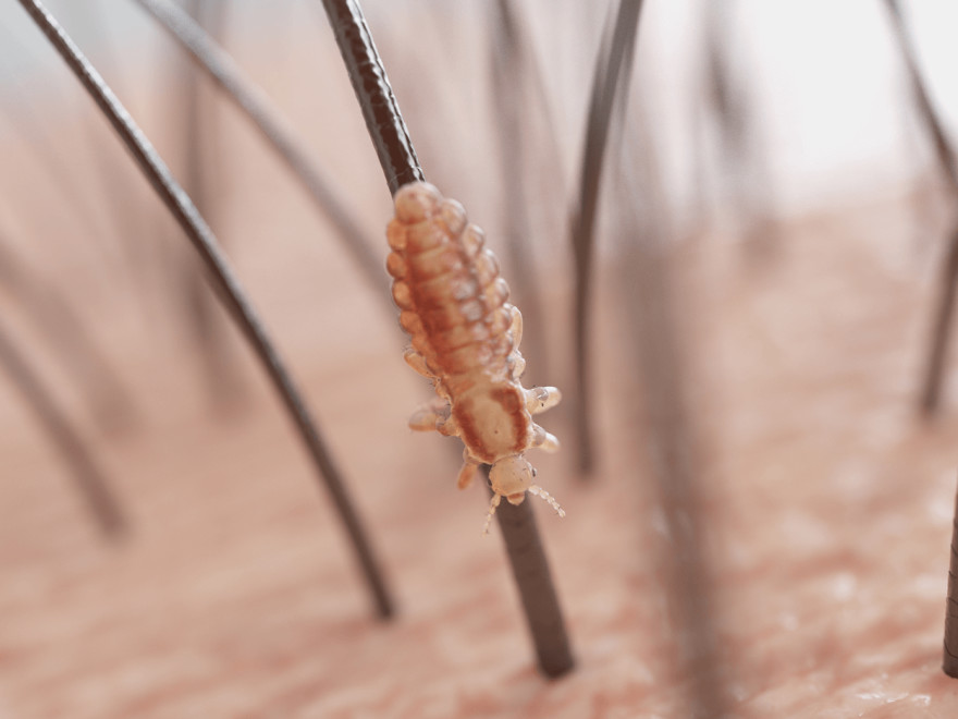 Con chấy ký sinh trên tóc người