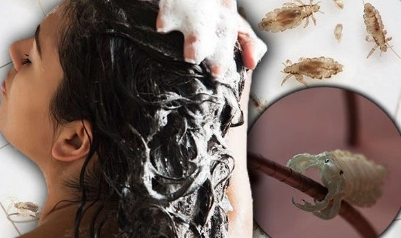 Gội đầu nhiều có hết chấy không?