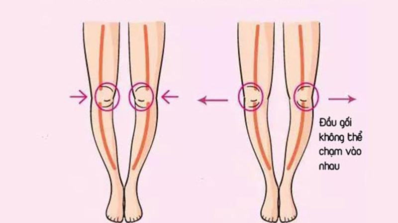 Nguyên nhân bị chân vòng kiềng