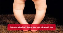 Chân vòng kiềng là gì? Nguyên nhân, nhận biết và cách chữa