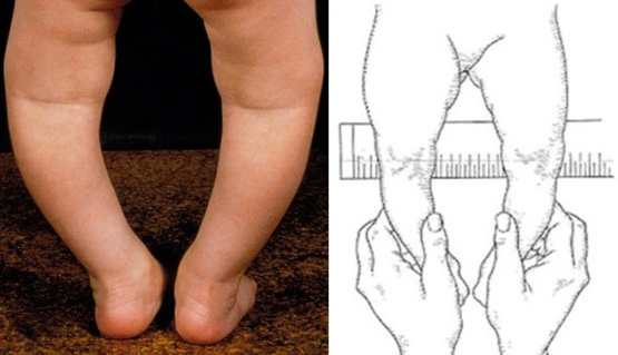 Cách nhận biết người bị chân vòng kiềng