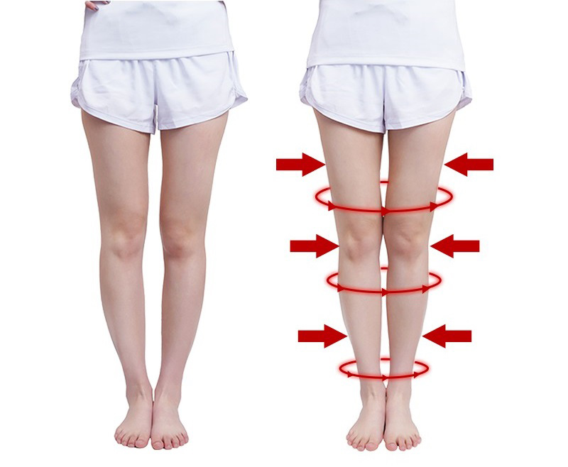 Cách chữa chân vòng kiềng
