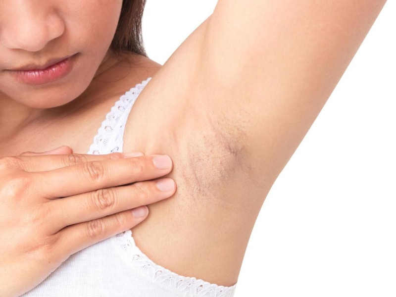 Để lông nách có bị hôi nách không?
