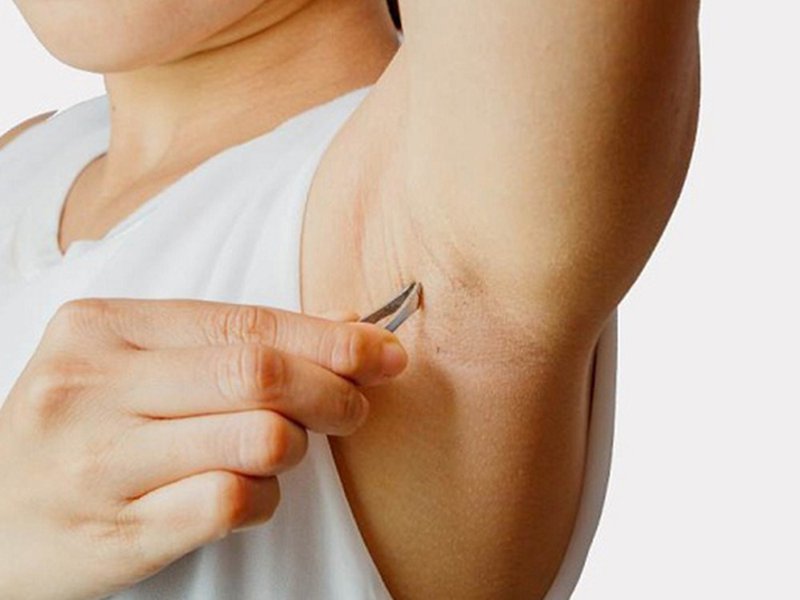 Có bị hôi nách sau khi triệt lông không?